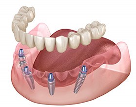 Illustration of All-on-4 denture