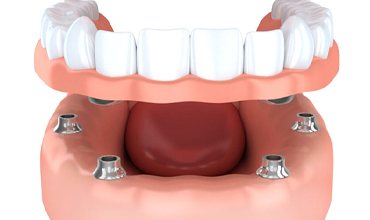 implant-retained dentures in Chevy Chase 