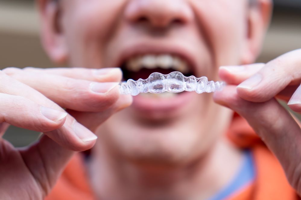 A man putting on an Invisalign aligner.